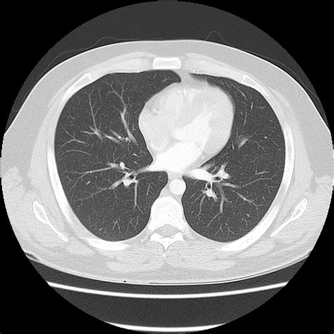 the villages lung ct scan
